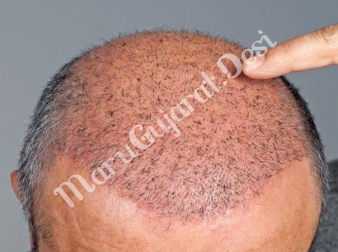 hair-transplant-eliminates-hair-loss-learn-complete-process-and-costs